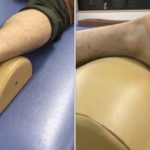 セーバー病、踵の痛みのテーピング法