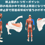 棘上筋のトリガーポイント