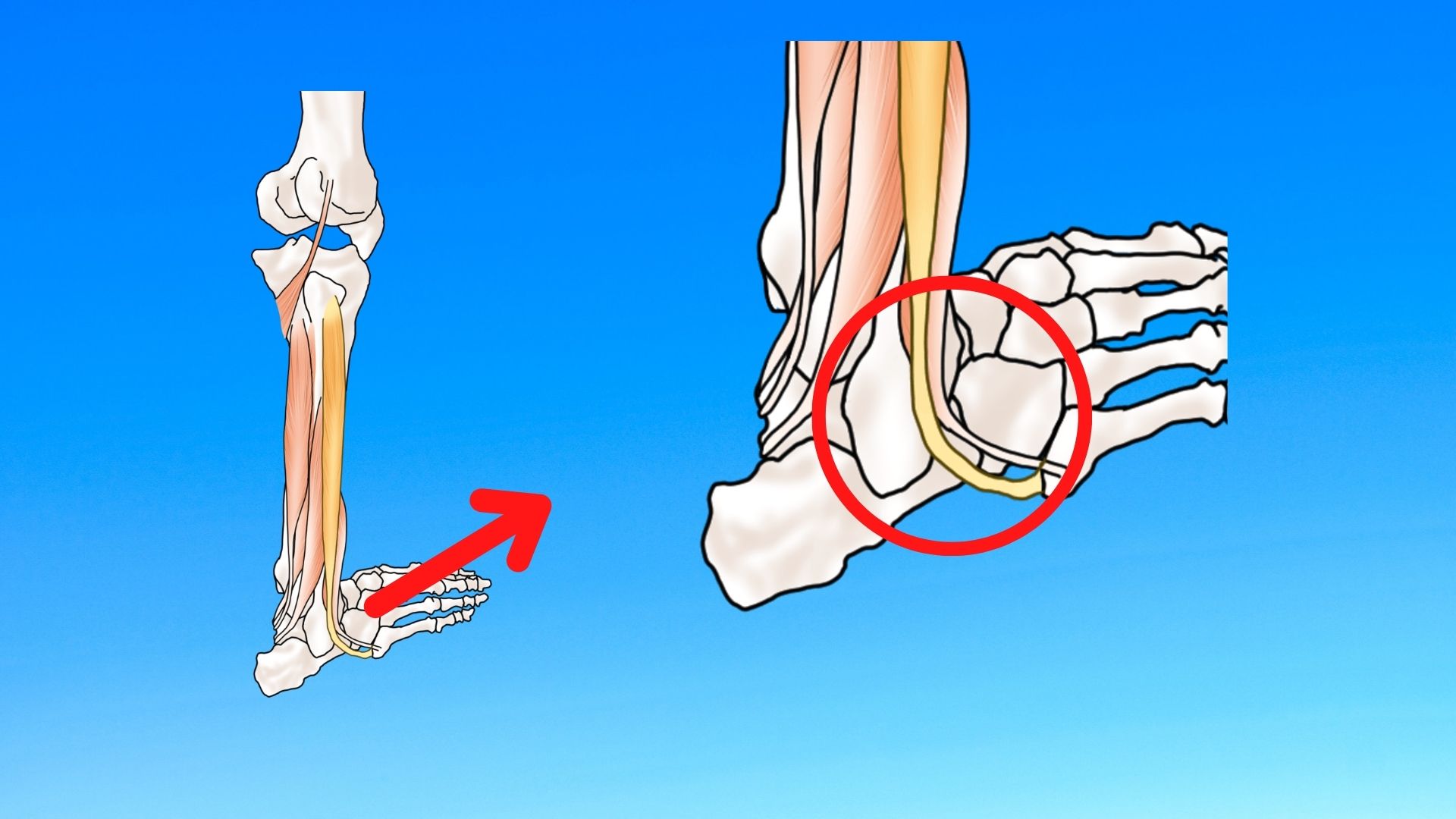 腓骨筋腱炎を予防する方法