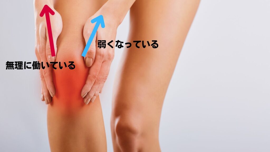 膝の痛み（変形性膝関節症）の電気鍼の一例