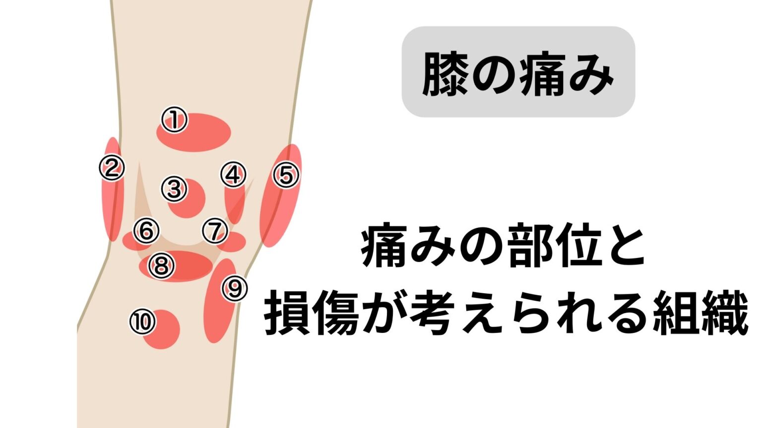 大腿四頭筋腱炎の治療